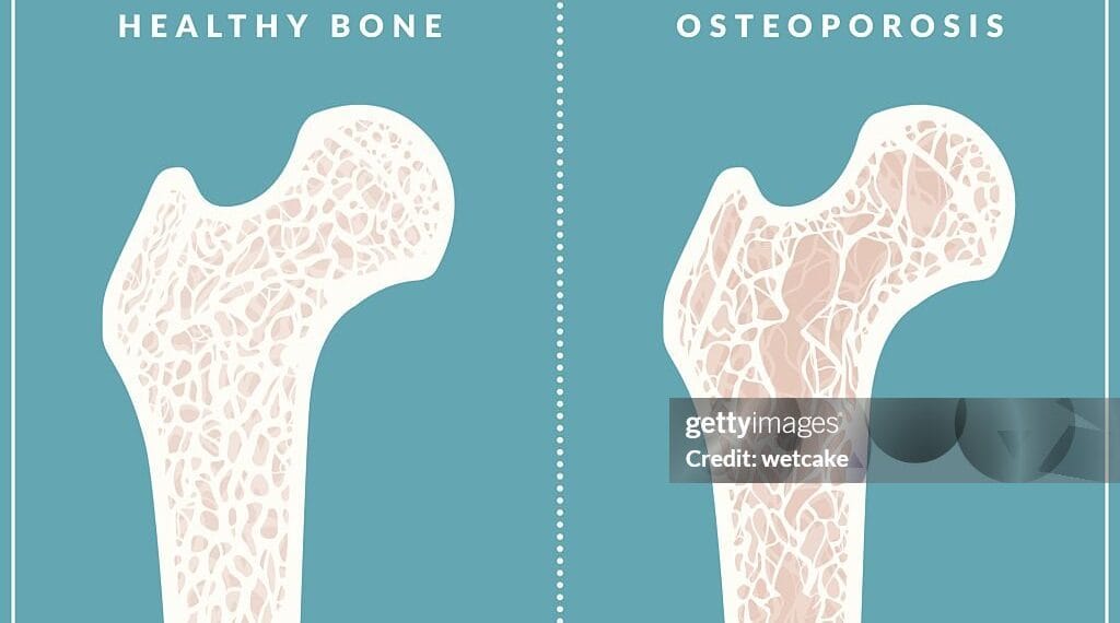 Bone Health and Osteoporosis Prevention