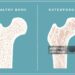 Bone Health and Osteoporosis Prevention